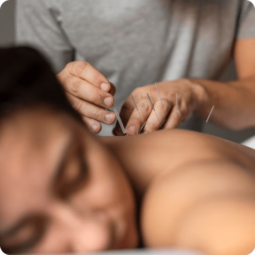 acupuncture img